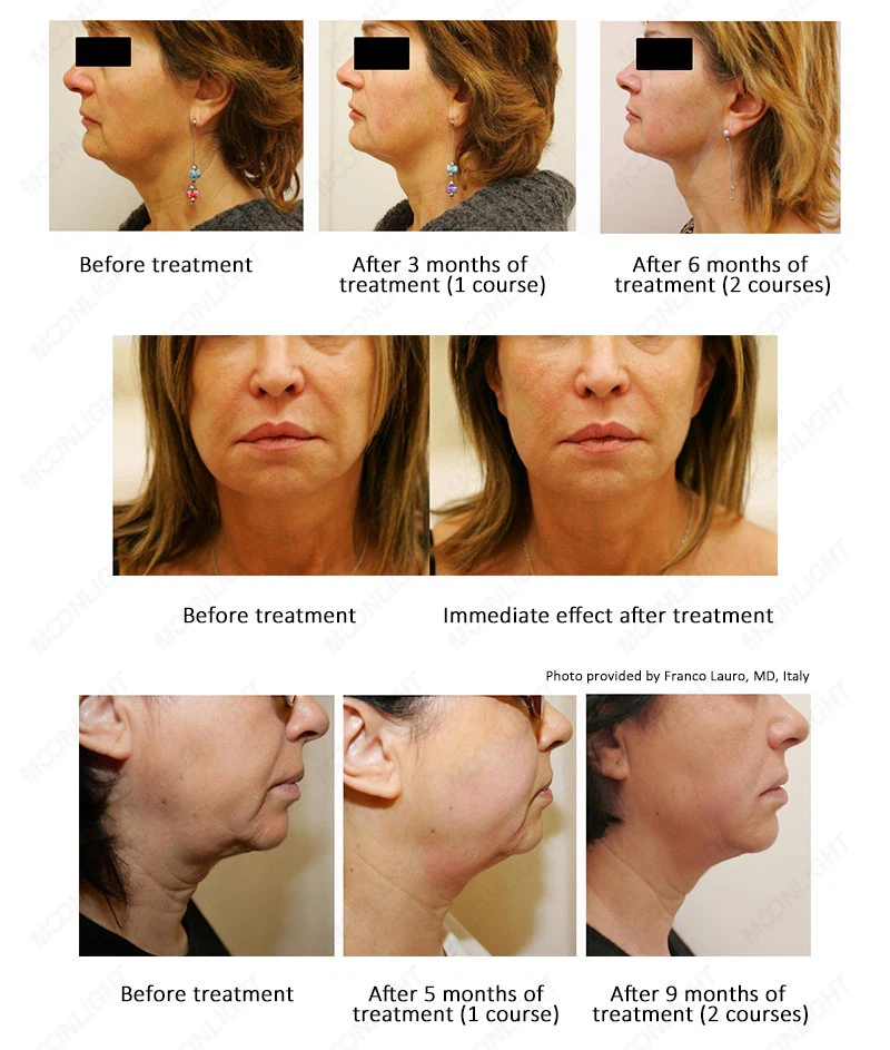 2024 Best 4D 10D 12D Hifu Beauty Machine