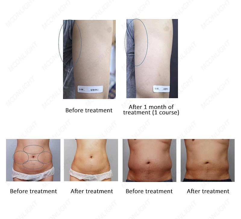 2024 Best 4D 10D 12D Hifu Beauty Machine